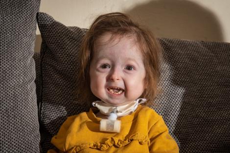 Isla Kilpatrick-Screaton e singura persoană din lume cu mutația ”Benjamin Button”. Cum o afectează condiția pe micuță